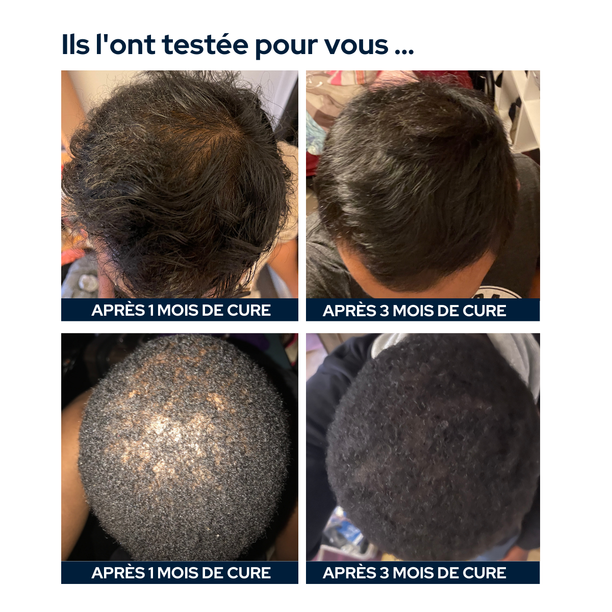 Cure anti-chute de cheveux hommes - anti-calvitie - epycure