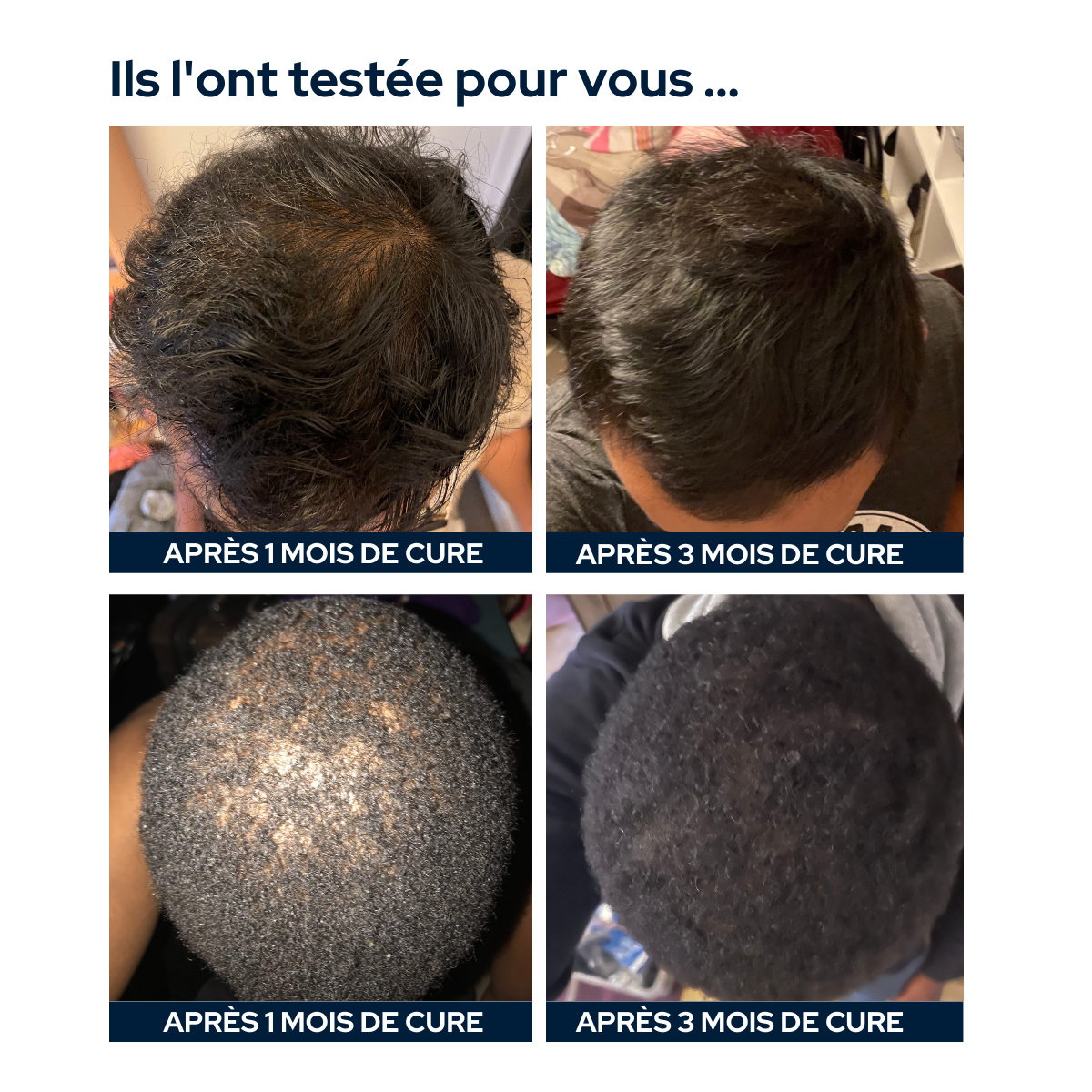 Cure anti-chute de cheveux hommes