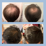 Cure anti-chute de cheveux hommes