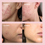 Gummies anti-imperfections