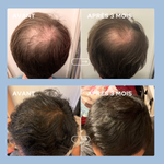 Anti-hair loss treatment for men