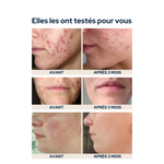 Gummies anti-imperfections